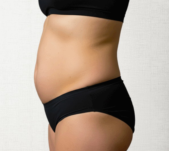 太もものビフォーアフター