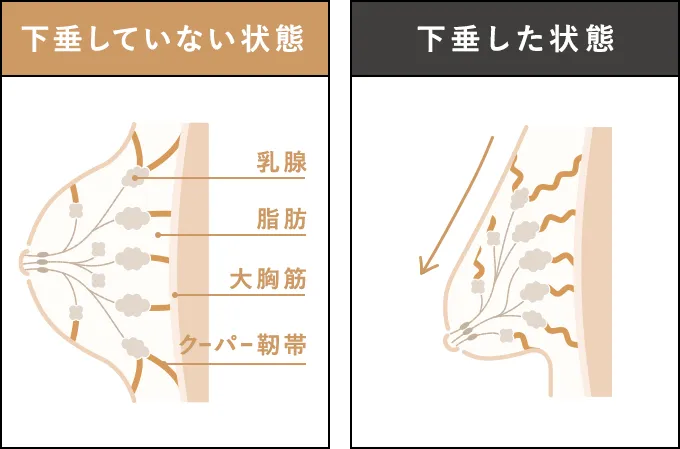 下垂していない状態／下垂した状態
