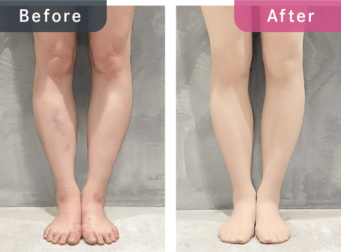 着圧タイツ着用前後の比較写真