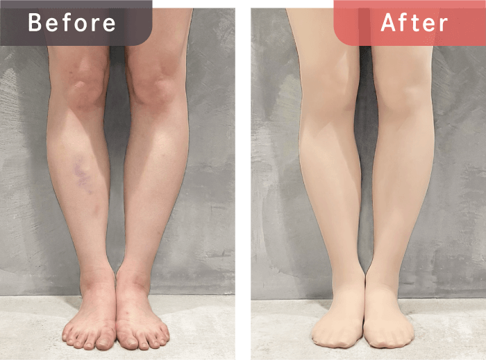 着圧タイツ着用前後の比較写真