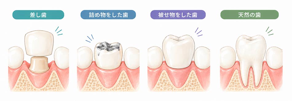 差し歯、詰め物、被せ物などの人工物と天然の歯