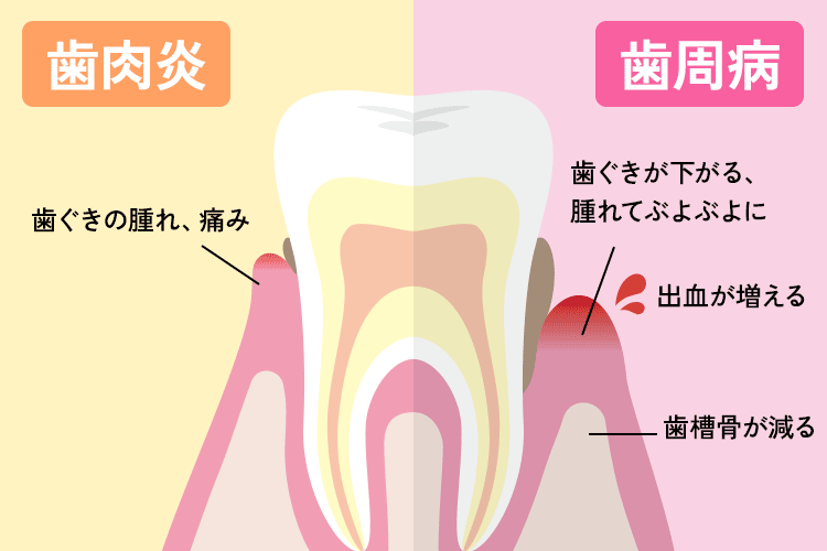 歯肉炎と歯周炎