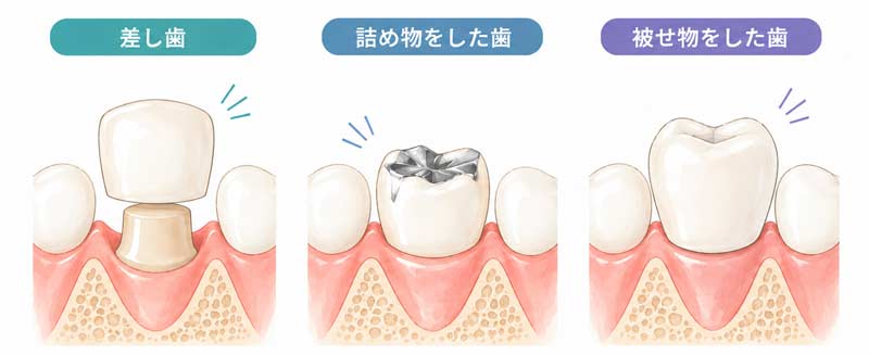 差し歯、被せ物、詰め物などの人工物