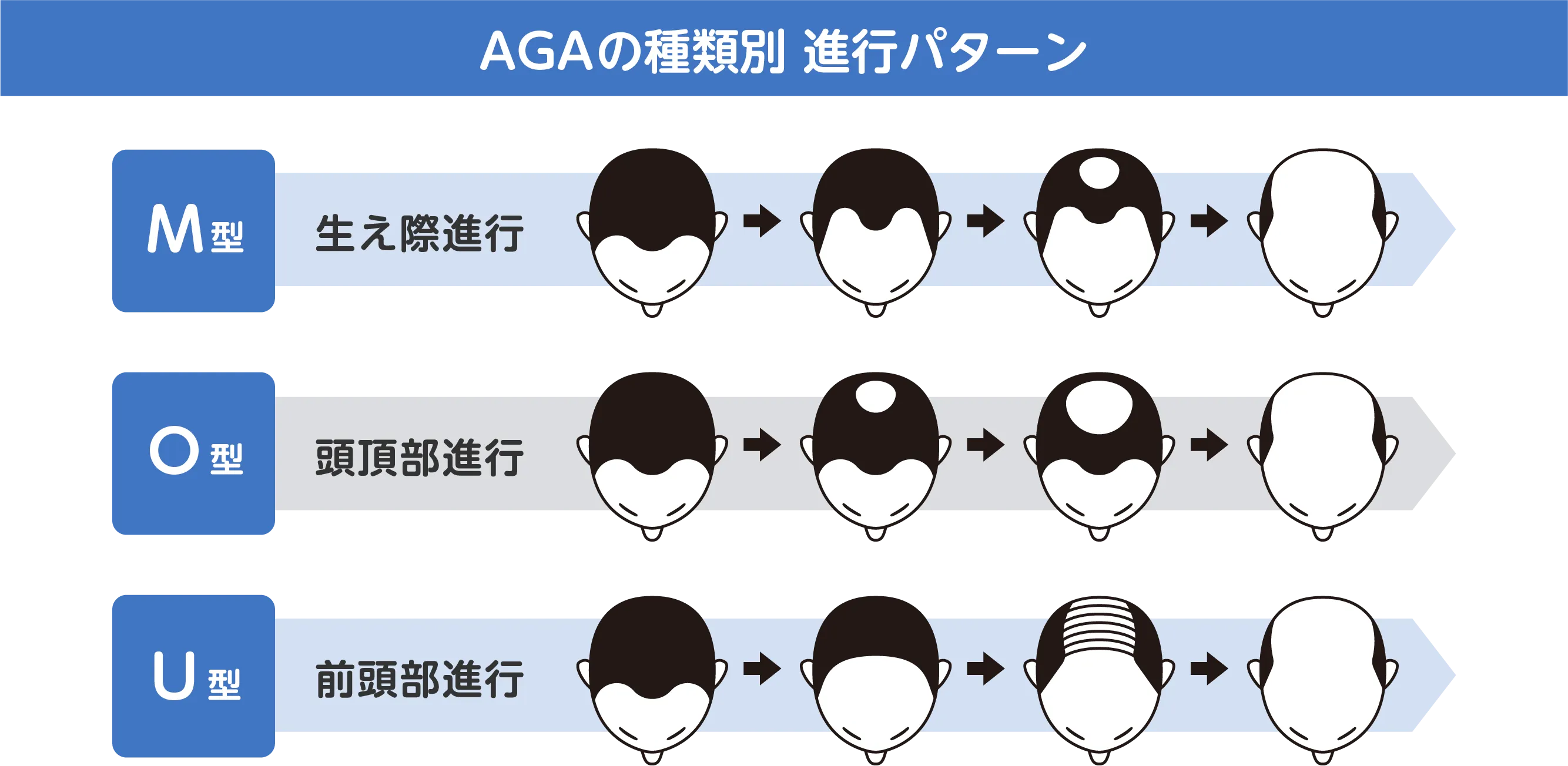 M字・O字・U字に見える薄毛パターン