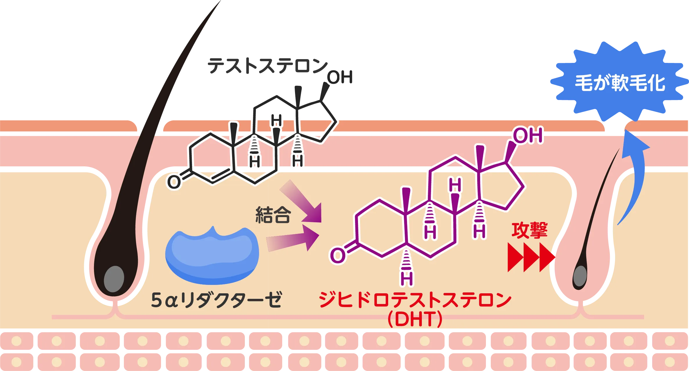 M字・O字・U字に見える薄毛パターン
