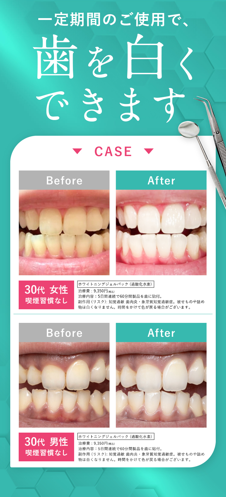 一定期間のご使用で、確実に歯が白くなります