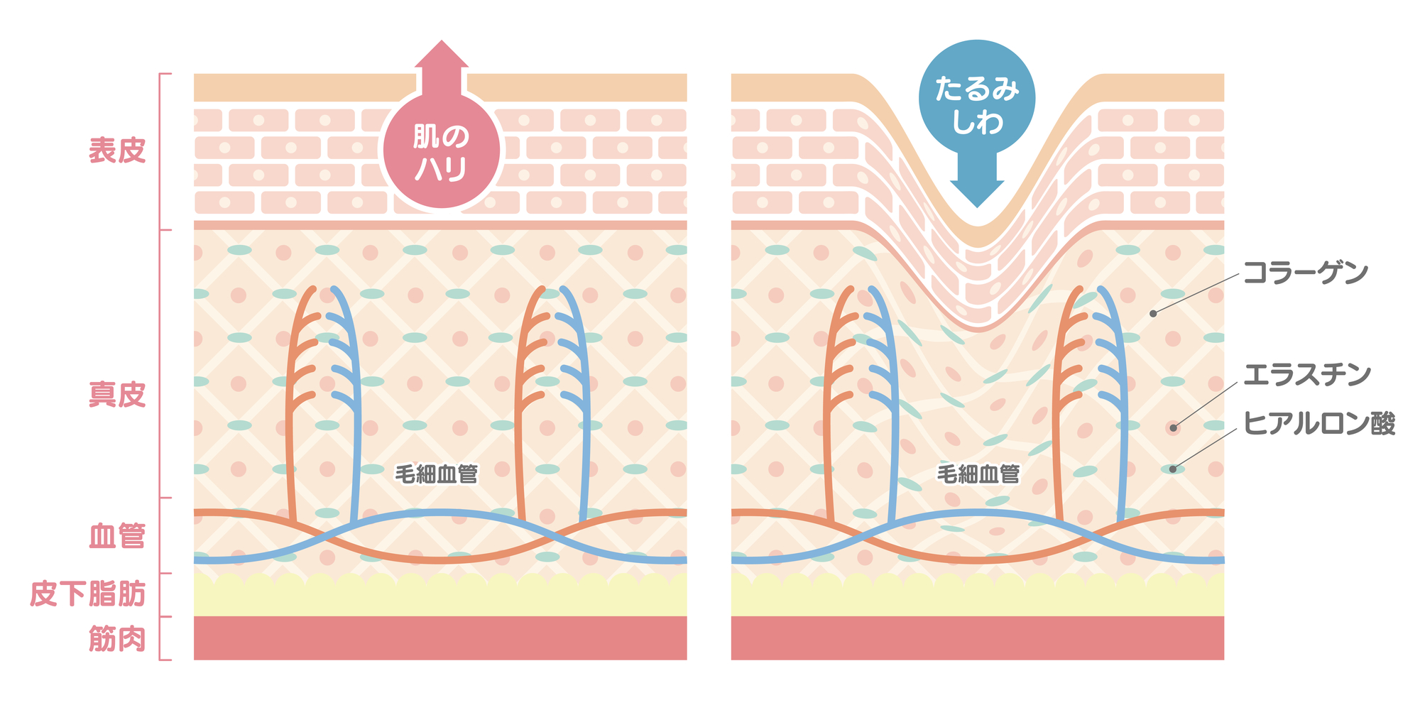 皮膚のたるみが原因でほうれい線が目立ってしまうメカニズム
