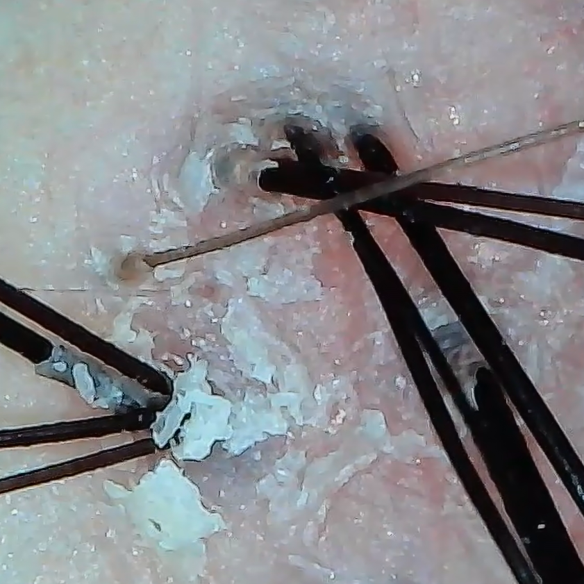 洗浄前の頭皮マイクロスコープ画像（Before）