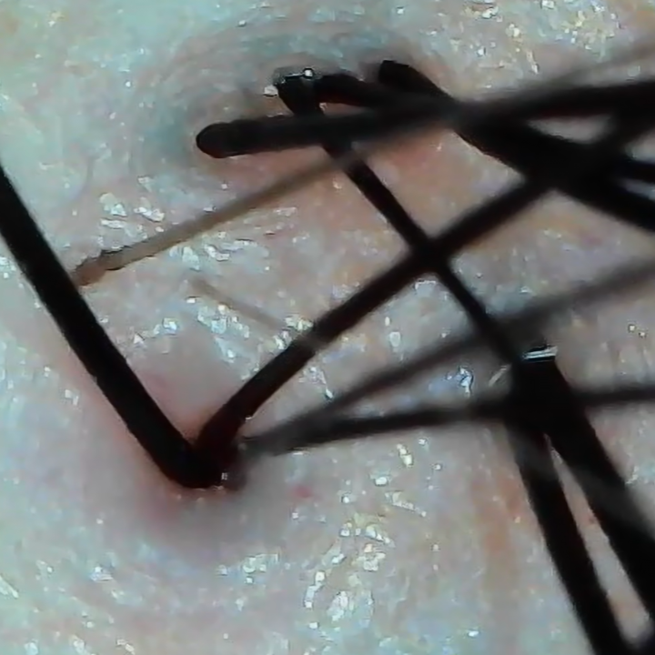 洗浄後の頭皮マイクロスコープ画像（After）