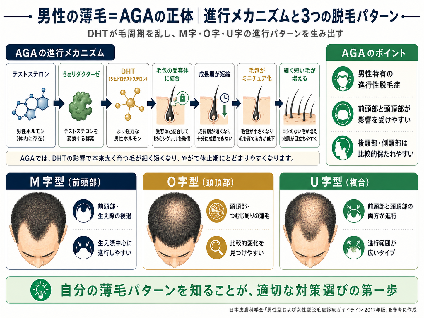 男性の脱毛パターン M字・O字・U字