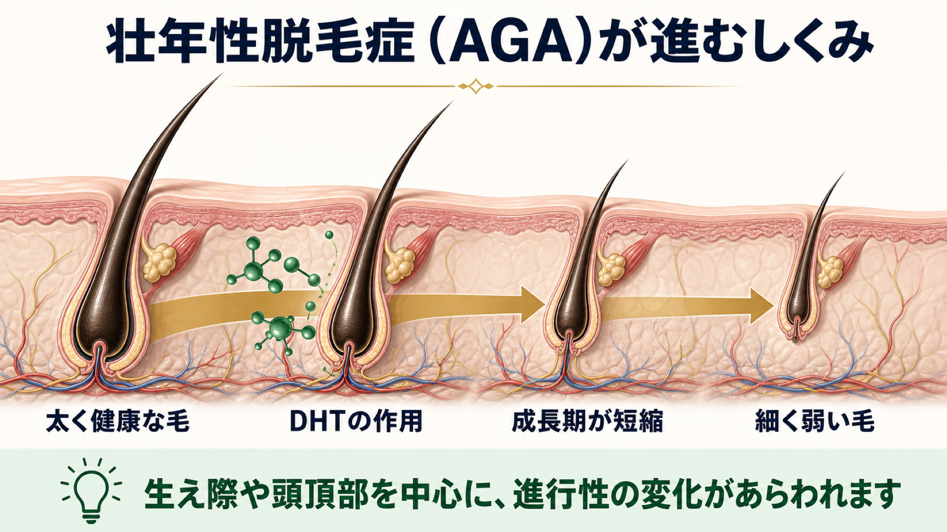 壮年性脱毛症が進む仕組み