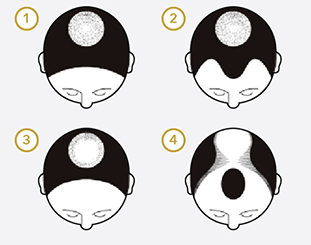 この医薬品の対象となる壮年性脱毛症