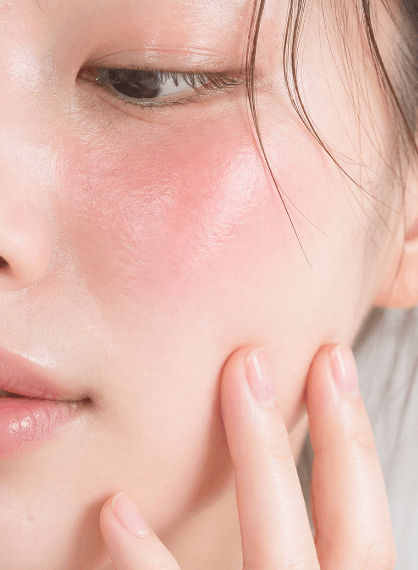 揺らぎやすい・赤みが出やすい・季節の変わり目