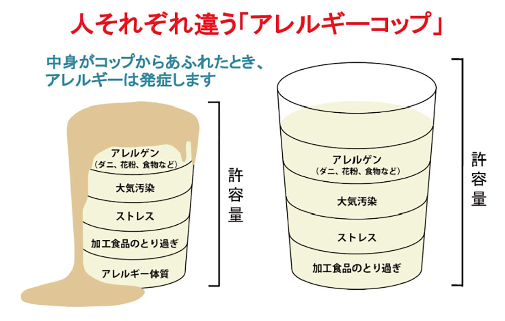 「アレルギーのコップ」の概念図。許容量を超えてアレルゲンなどが蓄積し、溢れた時に発症する仕組みを解説。