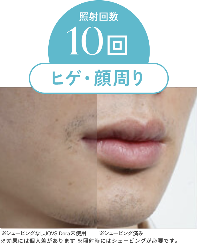 照射回数10回ヒゲ・顔周りbefore/after