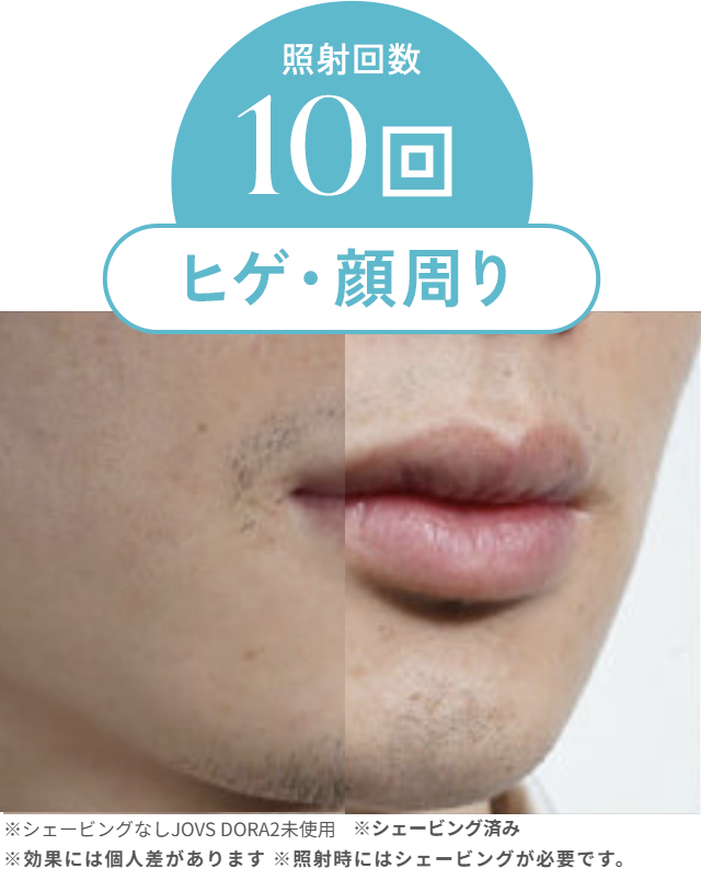 照射回数10回ヒゲ・顔周りbefore/after