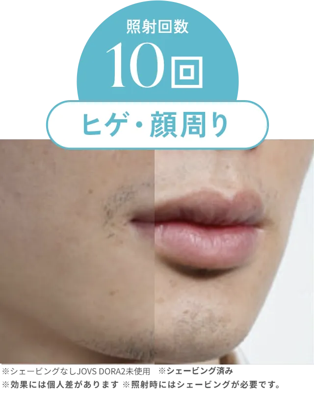 照射回数10回ヒゲ・顔周りbefore/after