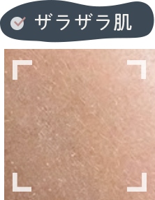 ザラザラ肌