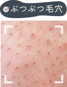 ぷつぷつ毛穴