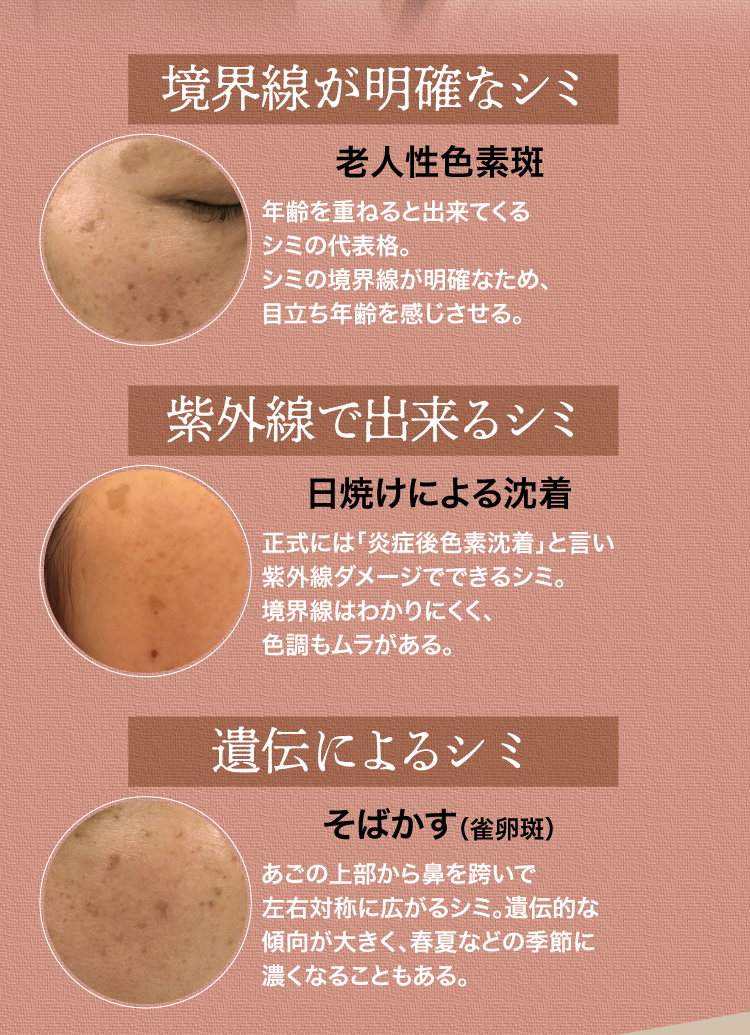 境界線が明確なシミ