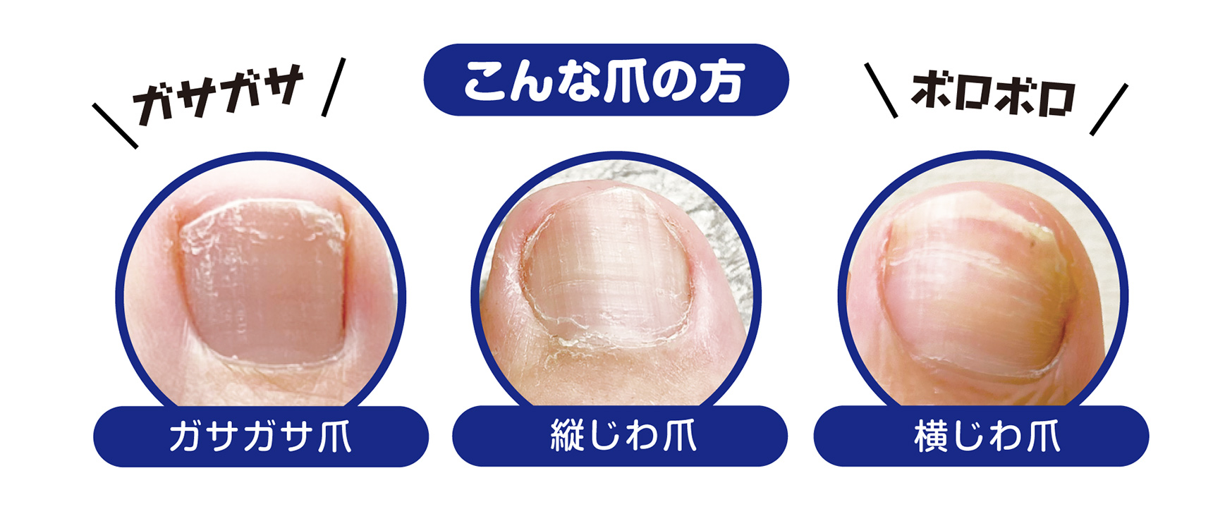 こんな爪の方 ガサガサ爪/縦じわ爪/横じわ爪
