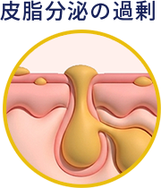 皮脂分泌の過剰