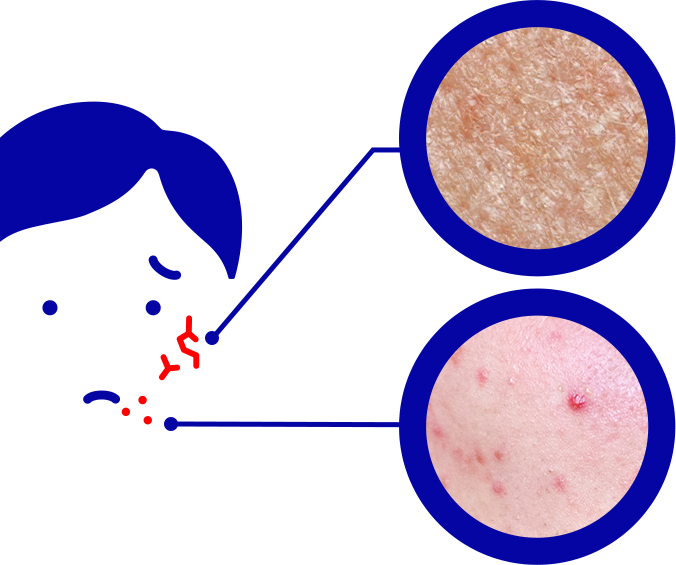 肌荒れしている男性のイラスト