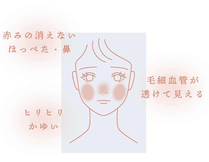 「赤みの消えないほっぺた・鼻」「毛細血管が透けて見える」「ヒリヒリかゆい」