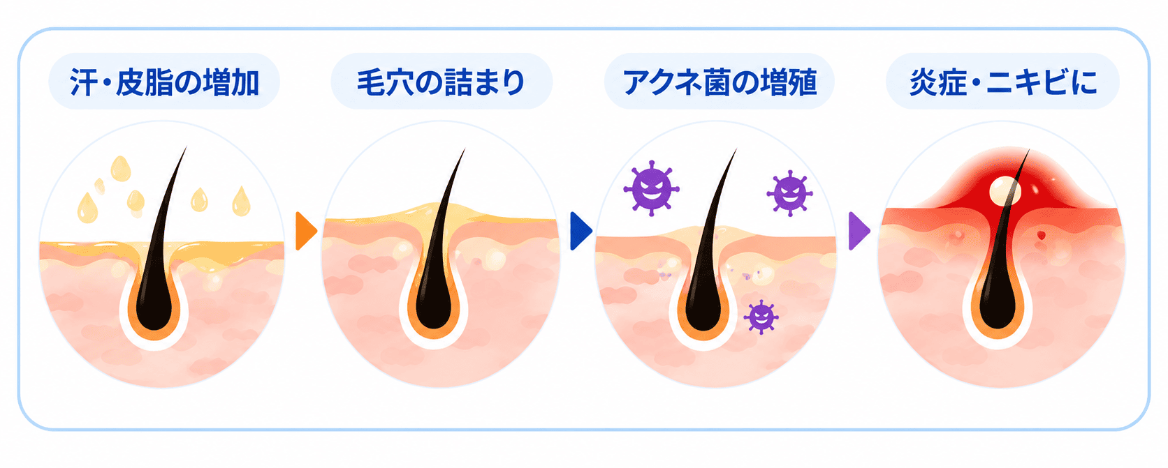 夏に頭皮ニキビが増える原因