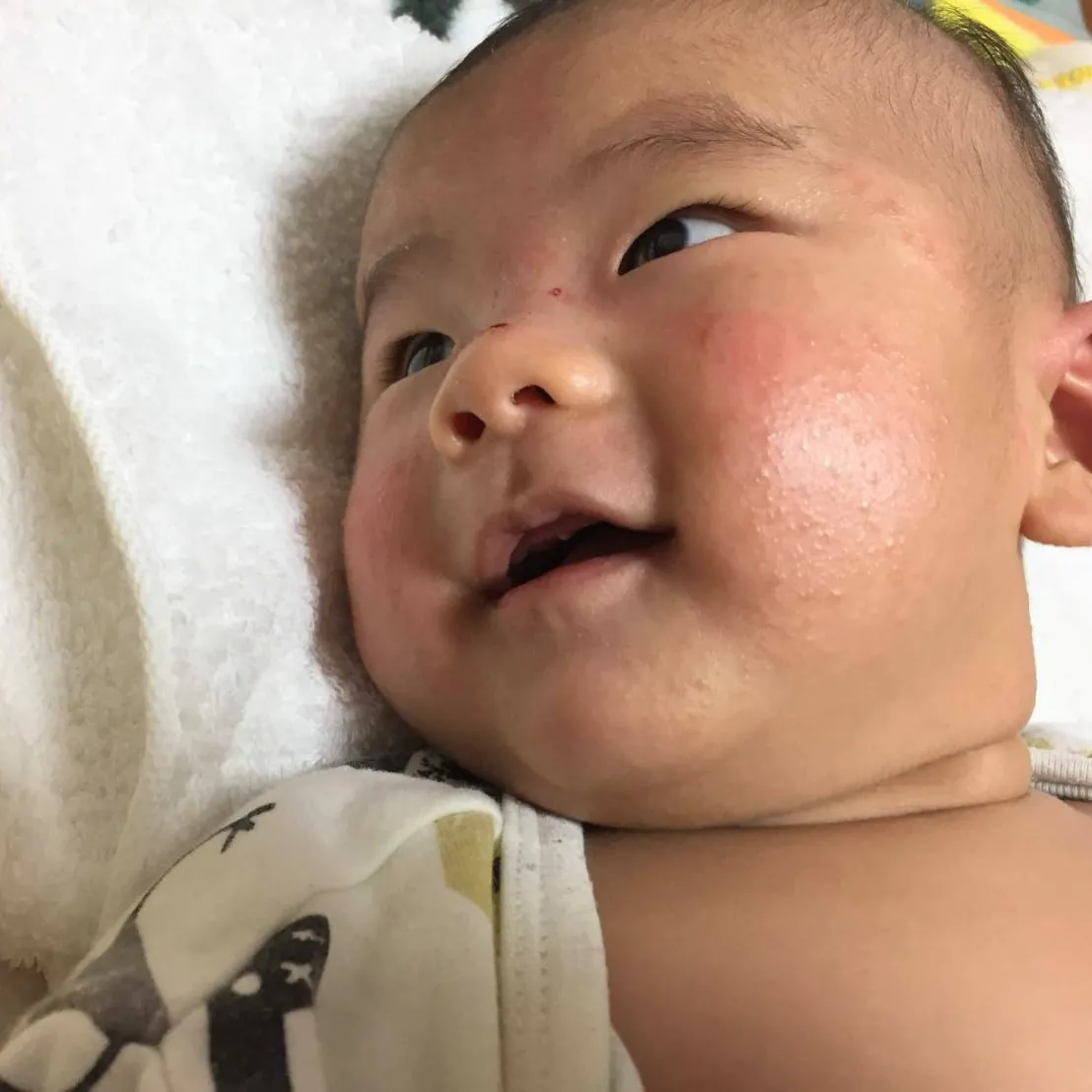 赤ちゃんに現れやすいアレルギーの特徴