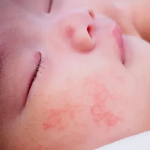 赤ちゃんのときに発症したアレルギーは治るの？