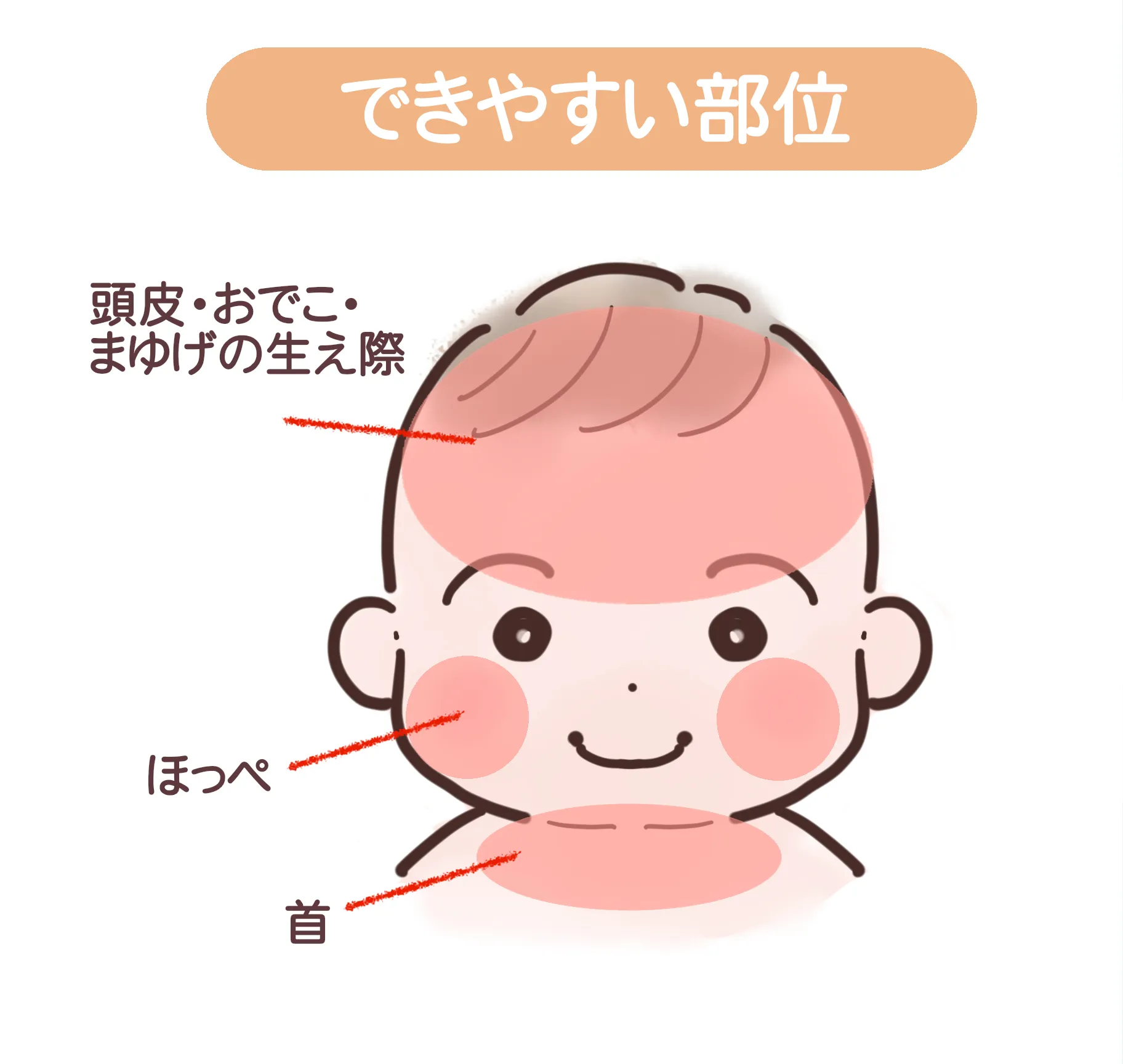 できやすい部位