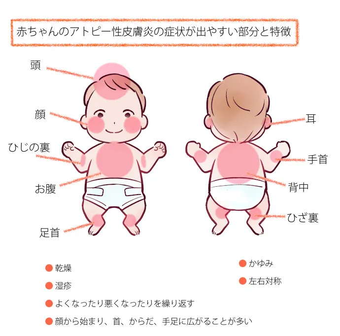 赤ちゃんのアトピー性皮膚炎の症状が出やすい部位と特徴