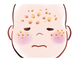 乳児脂漏性湿疹はほっといても大丈夫?いつから・いつまで続くのか