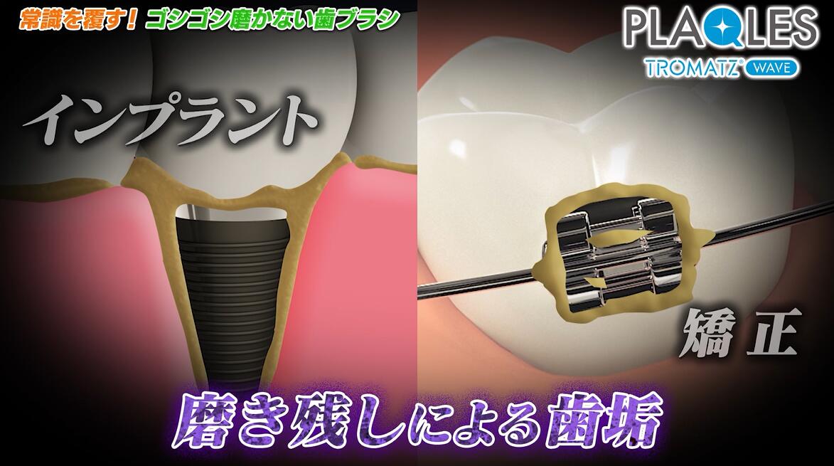 PLAQLES（プラクレス）【通常価格】39,800円（税込43,780円）