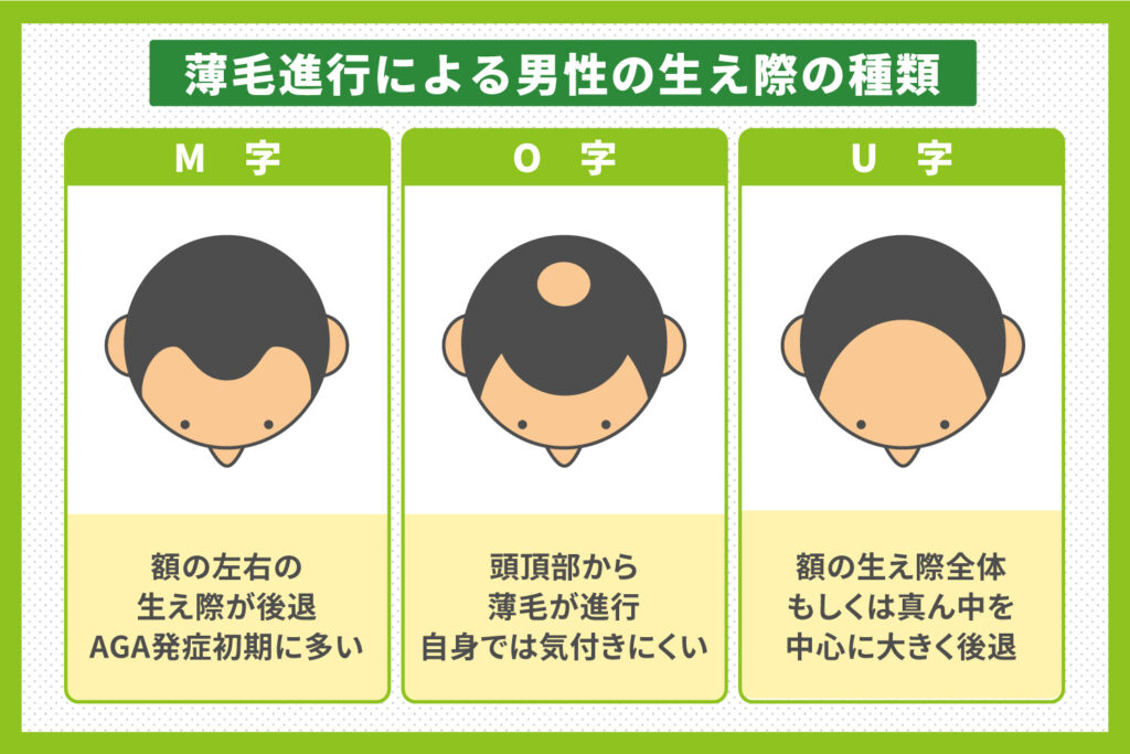 薄毛進行による男性の生え際の種類