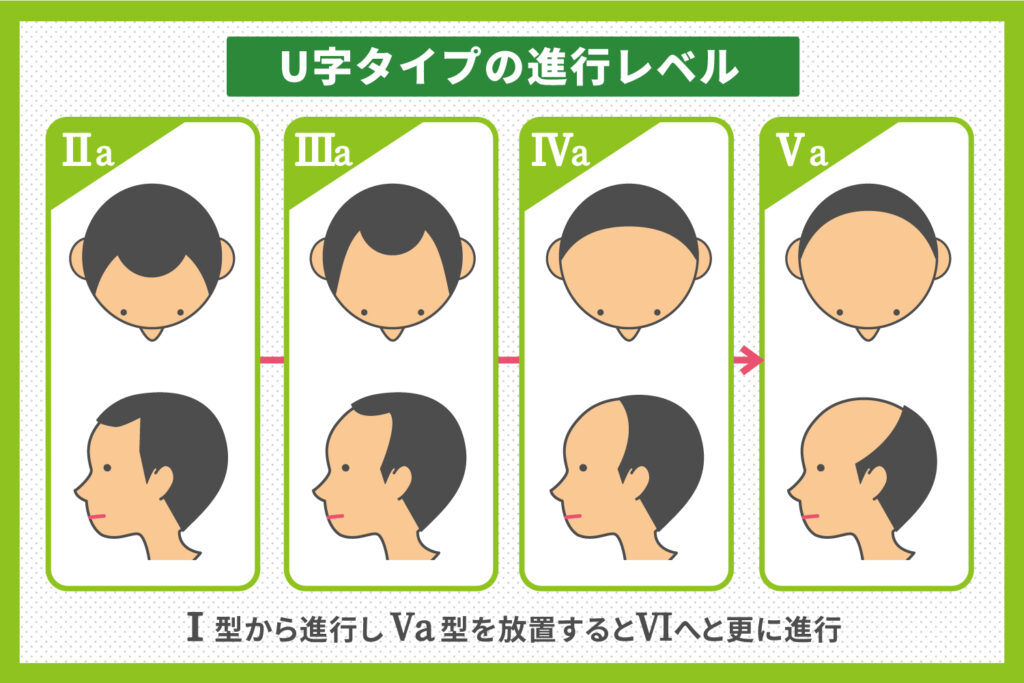 U字タイプの進行レベル