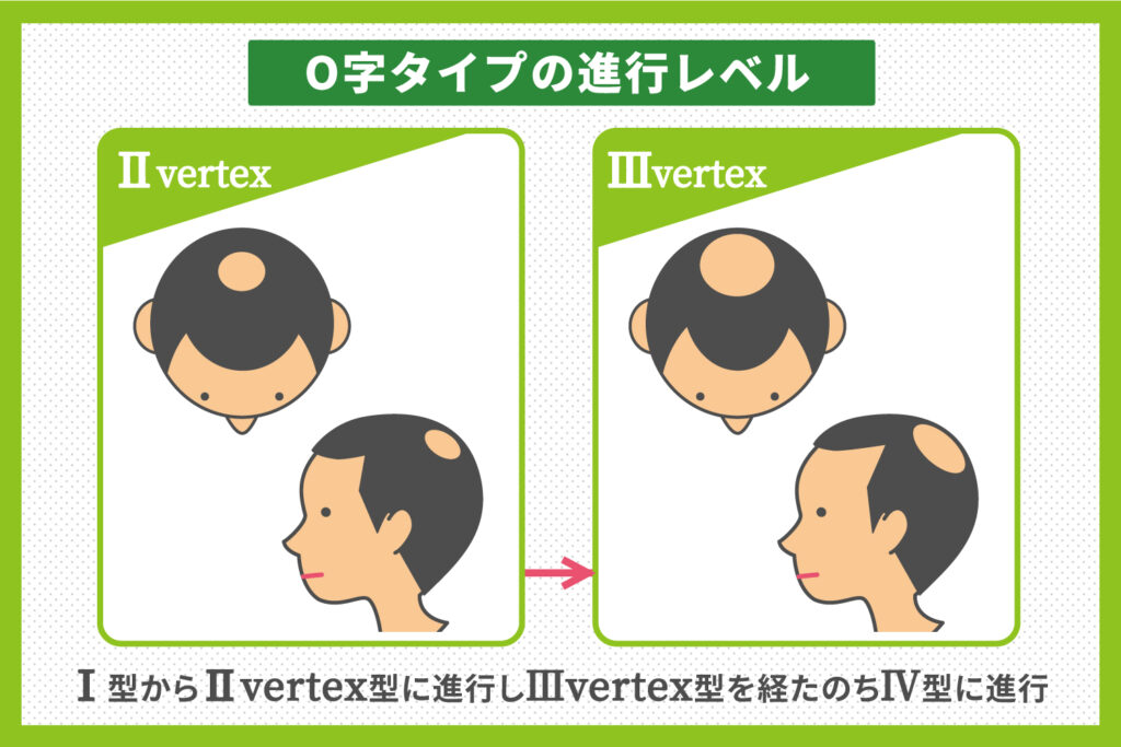O字タイプの進行レベル