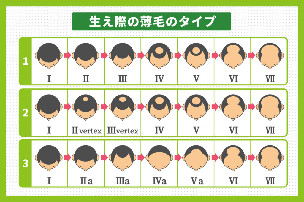 生え際の薄毛のタイプ