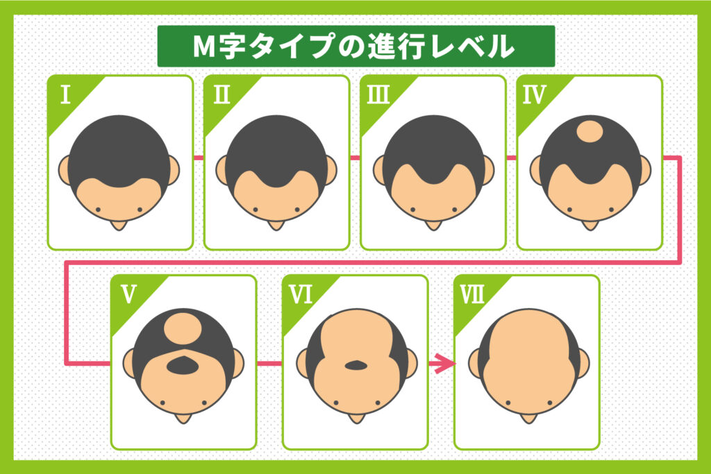 M時タイプの進行レベル