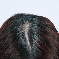 「蘭夢」を頭皮に直接つける