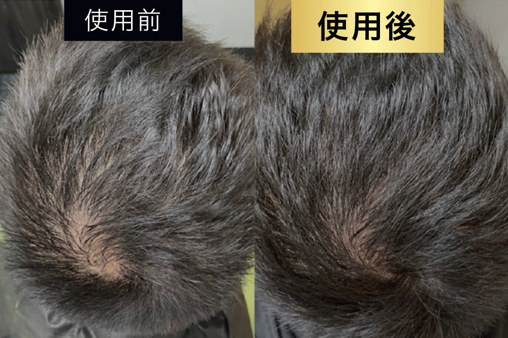 育毛効果臨床試験済み