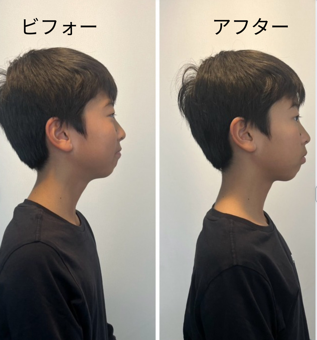 【今だけ割引】整体ボールセット(大人用＋子供用)