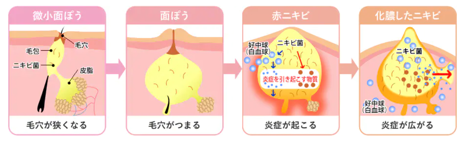 ニキビ跡