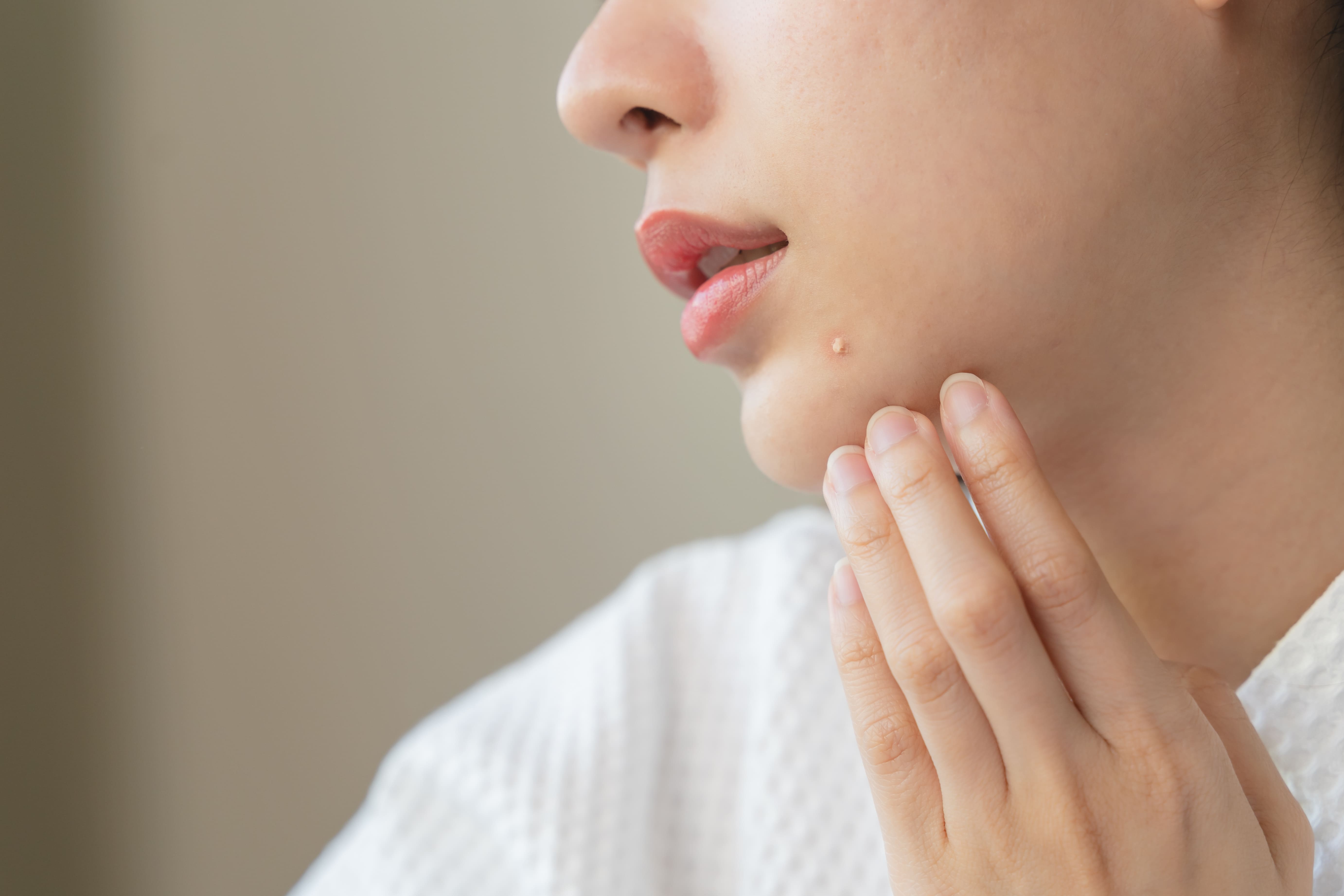 ニキビ跡の種類と正しいケア方法とは？