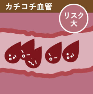 カチコチ血管