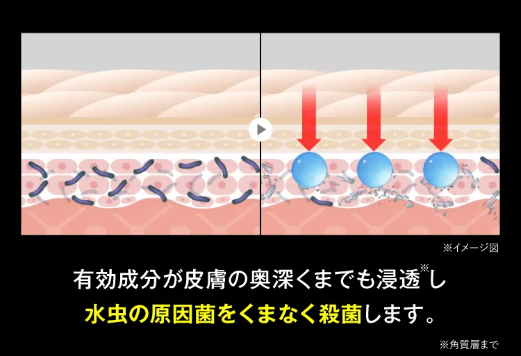 有効成分が奥深くまで浸透し水虫の原因菌をくまなく殺菌｜カカるるん