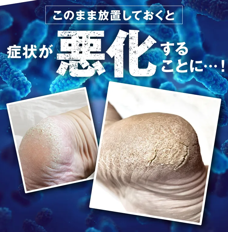 このまま放置しておくと症状が悪化することに｜カカるるん