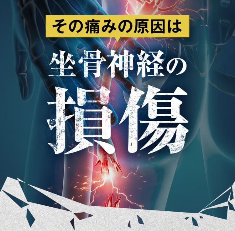 治らない坐骨神経痛｜ザコツフェリン