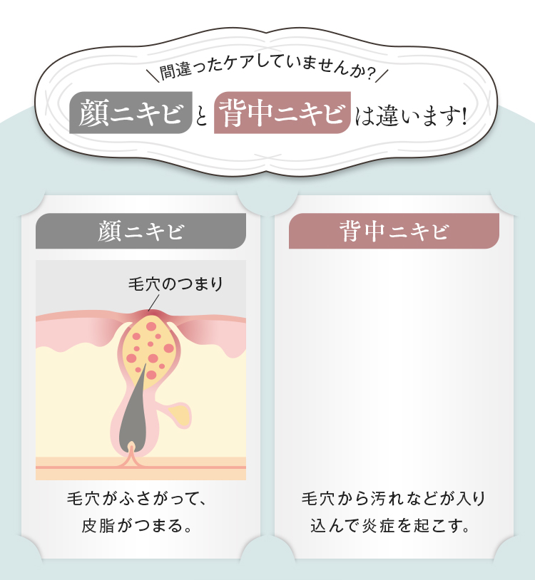 顔ニキビと背中ニキビは違います。